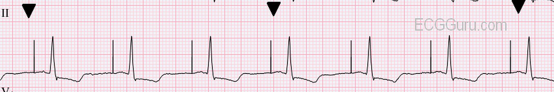 ecg-basics-atrial-pacing-ecg-guru-instructor-resources